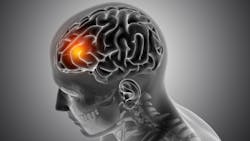 Adobe Brain Tumor Adobe Stock 321579997 6298c545a0f63 Adobe Brain Tumor Adobe Stock 321579997 6298c545a0f63