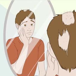 Adobe Alopecia Adobe Stock 465351758 62ab3c8ab6ae5 Adobe Alopecia Adobe Stock 465351758 62ab3c8ab6ae5