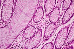 Adobe Cancer Adobe Stock 320367315 62b328066cf1c Adobe Cancer Adobe Stock 320367315 62b328066cf1c