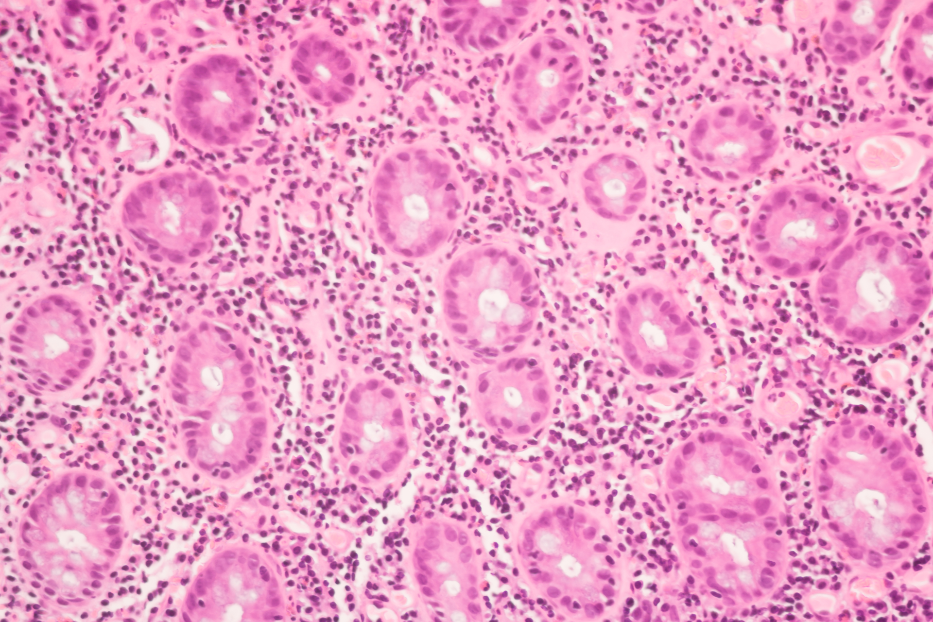 Adobe Cancer Cells Adobe Stock 320366946 62c847ed23802