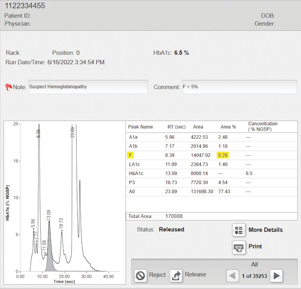 Figure 1: HbF detected on CE-HPLC A1c method &mdash; it provides information about the risk of possible interacting hemoglobinopathy.