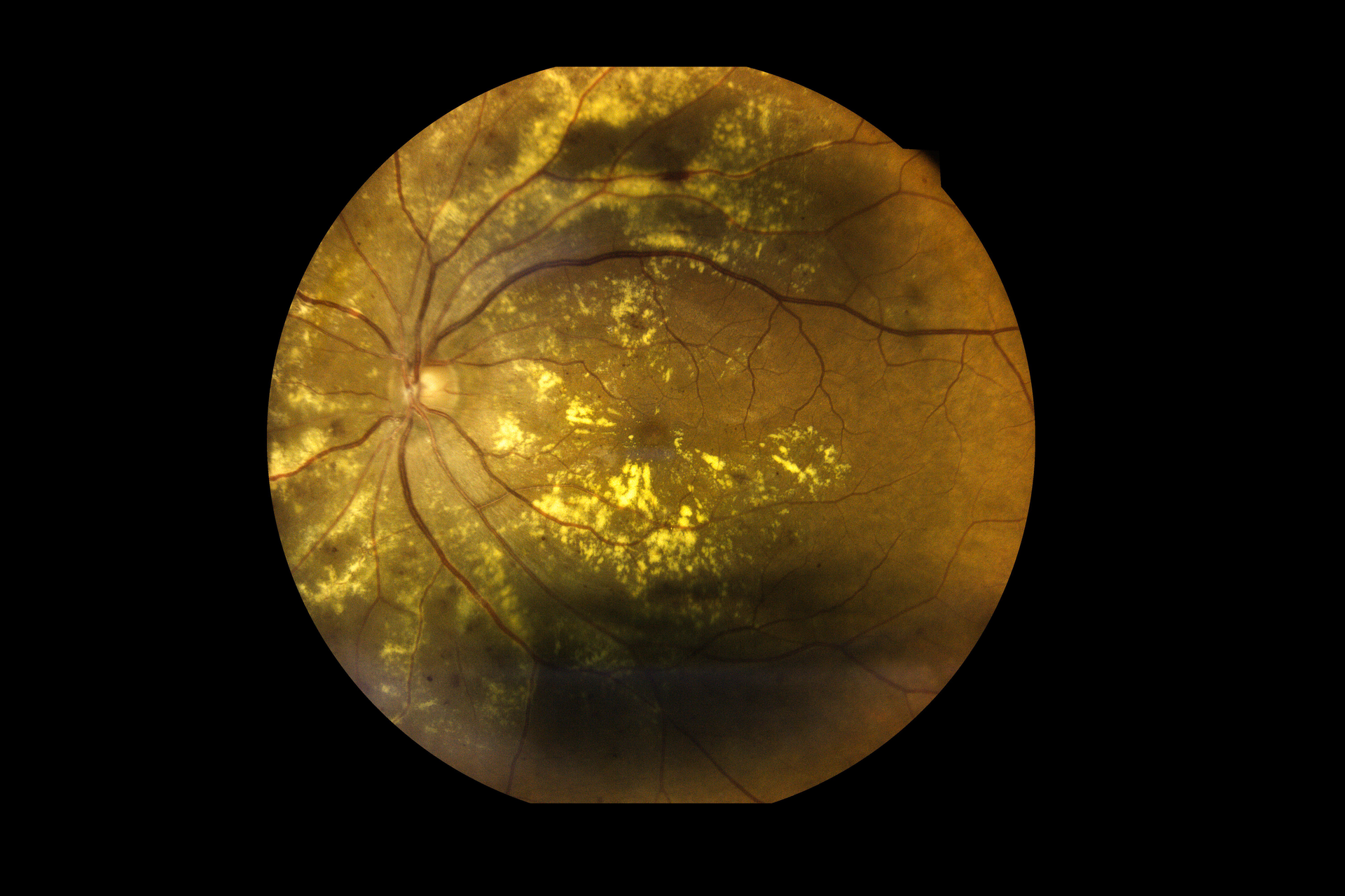 One Of Two Widely Used Macular Degeneration Drugs Outperforms Other   AdobeStock 396526228.6388c6ebeca91 