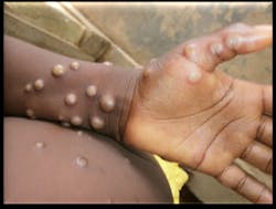Monkeypox in (pustular) stage Monkeypox in (pustular) stage