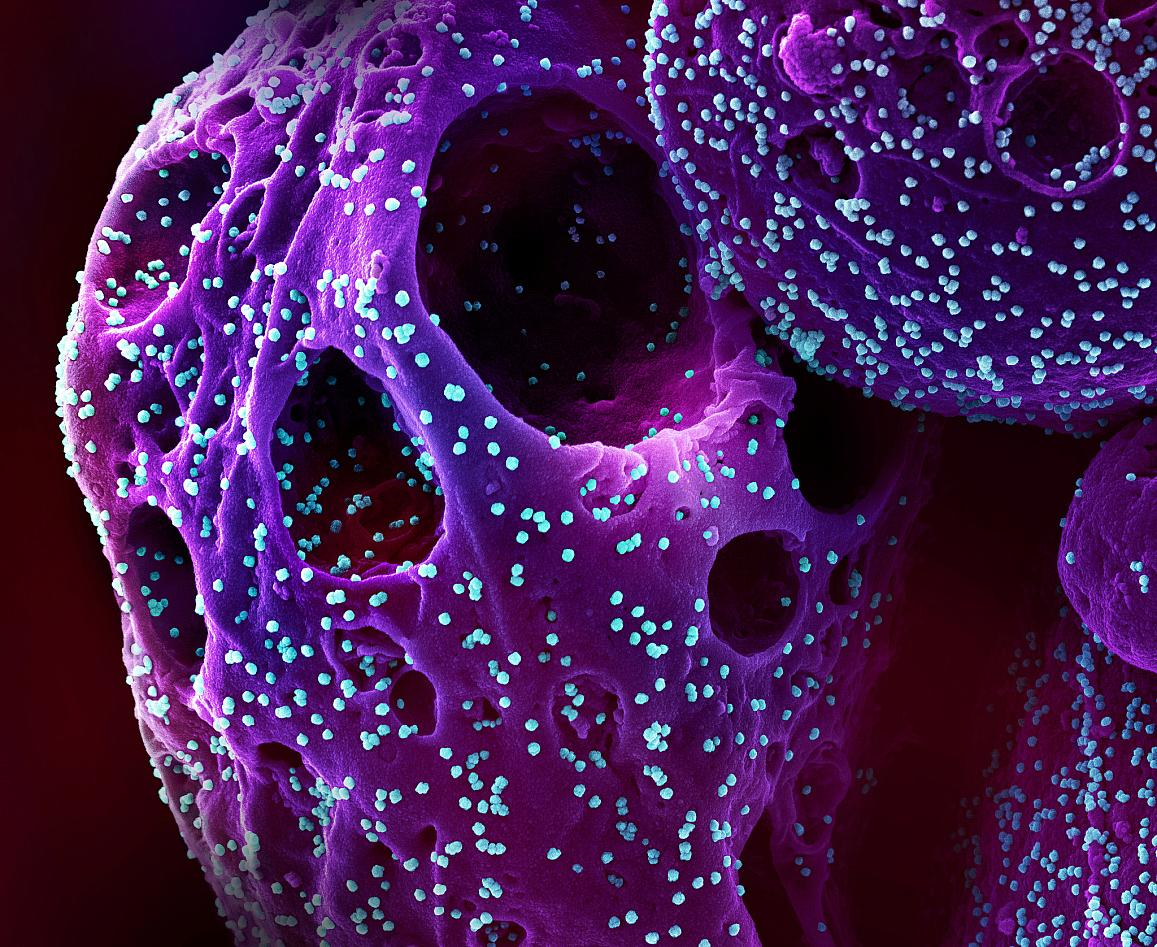 Colorized scanning electron micrograph of a cell (purple) infected with the Omicron strain of SARS-CoV-2 virus particles (teal), isolated from a patient sample. NIAID.