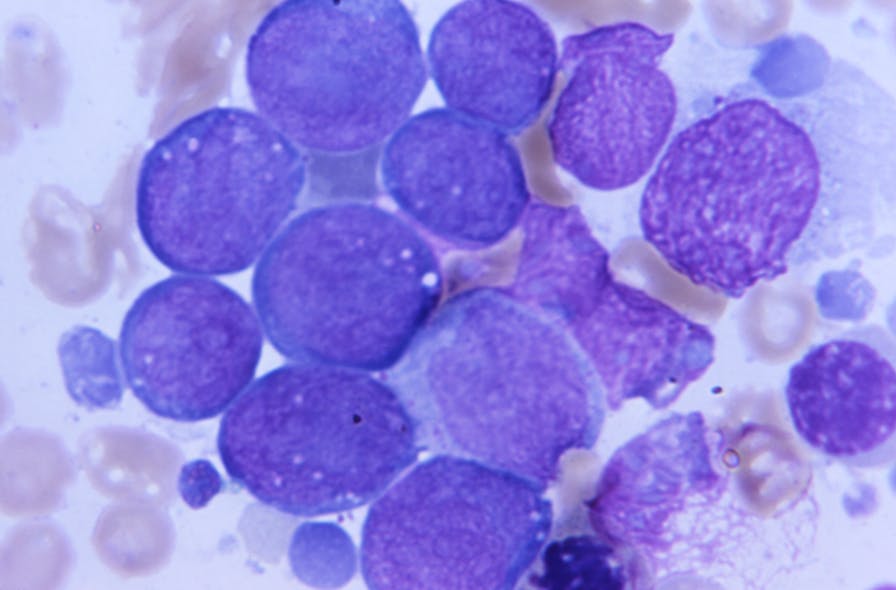 Blood test identifies acute myeloid leukemia patients at greater risk