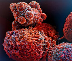 Colorized scanning electron micrograph of a cell (red) infected with the Omicron strain of SARS-CoV-2 virus particles (blue), isolated from a patient sample. NIAID. Colorized scanning electron micrograph of a cell (red) infected with the Omicron strain of SARS-CoV-2 virus particles (blue), isolated from a patient sample. NIAID.