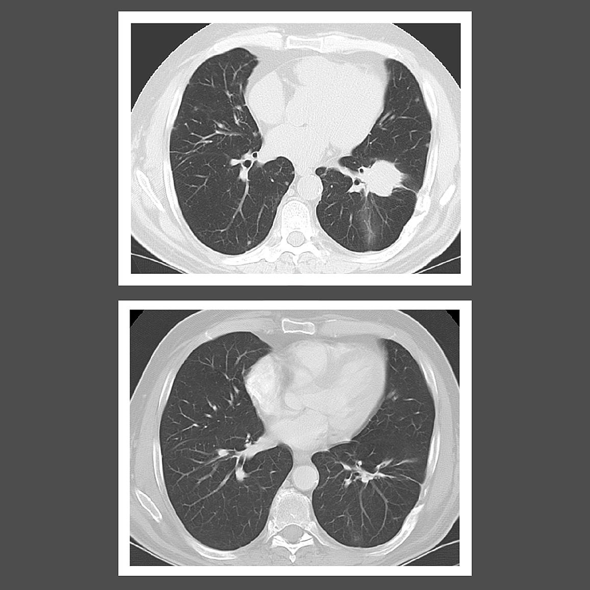 Treatment with interferon alfa-2b led to the disappearance of a large lesion (top image) in the lungs of a patient with lymphomatoid granulomatosis, as shown in this computed tomography chest scan. Courtesy of the Center for Cancer Research.