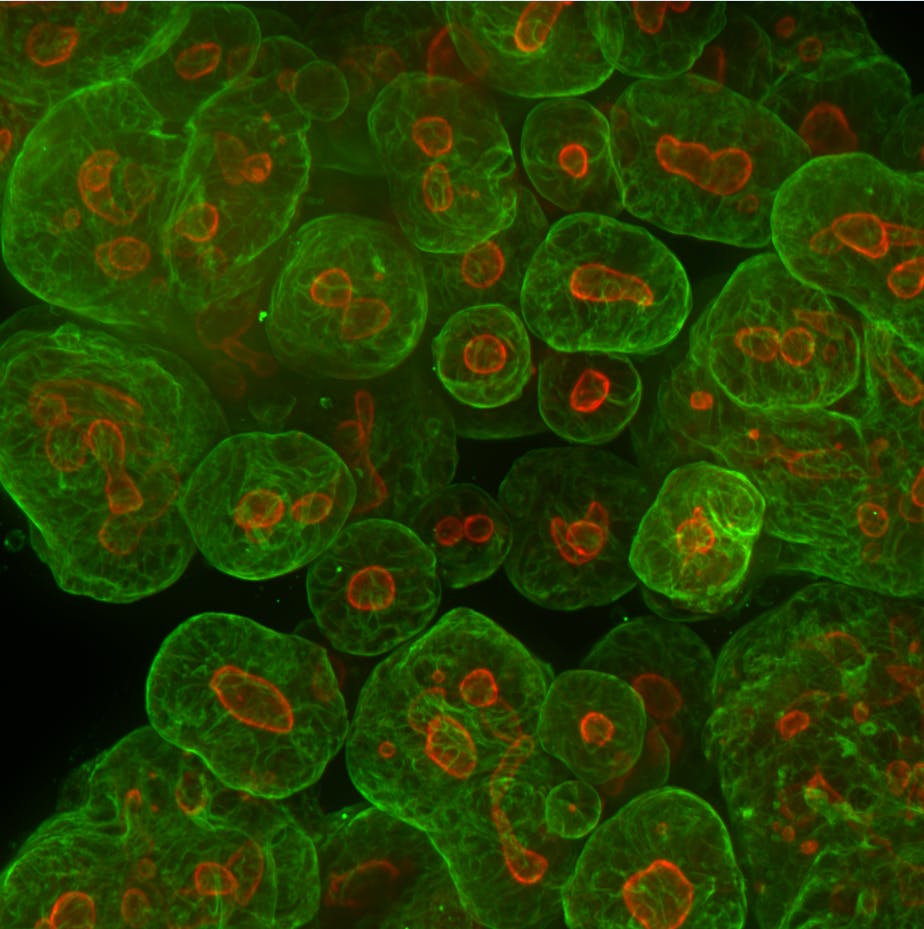 Tumoroid (also known as cancer organoid) cells established from a patient colorectal cancer sample are shown expressing proteins associated with cancer identity (green) and proliferation (red). Courtesy of Thermo Fisher Scientific.