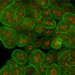 Tumoroid (also known as cancer organoid) cells established from a patient colorectal cancer sample are shown expressing proteins associated with cancer identity (green) and proliferation (red). Courtesy of Thermo Fisher Scientific.