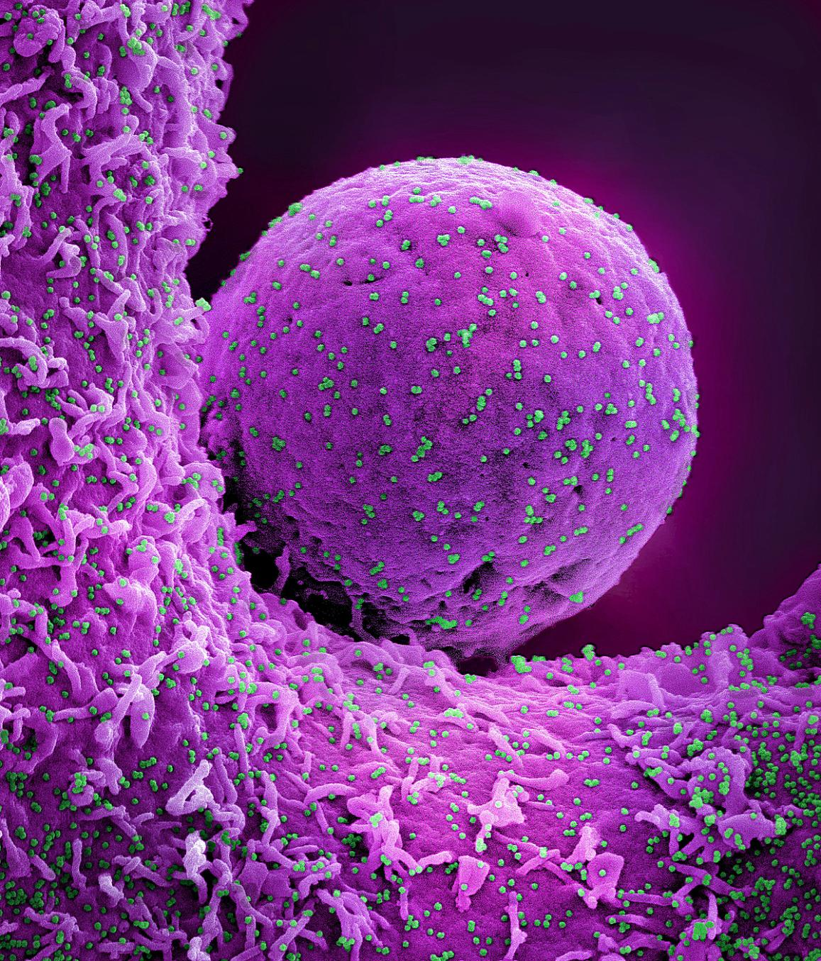 Colorized scanning electron micrograph of a cell (pink) infected with the Omicron strain of SARS-CoV-2 virus particles (teal), isolated from a patient sample. Image captured at the NIAID Integrated Research Facility (IRF) in Fort Detrick, Maryland. NIAID.