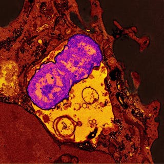 A human neutrophil (red) containing ingested Klebsiella pneumoniae (purple). NIAID.