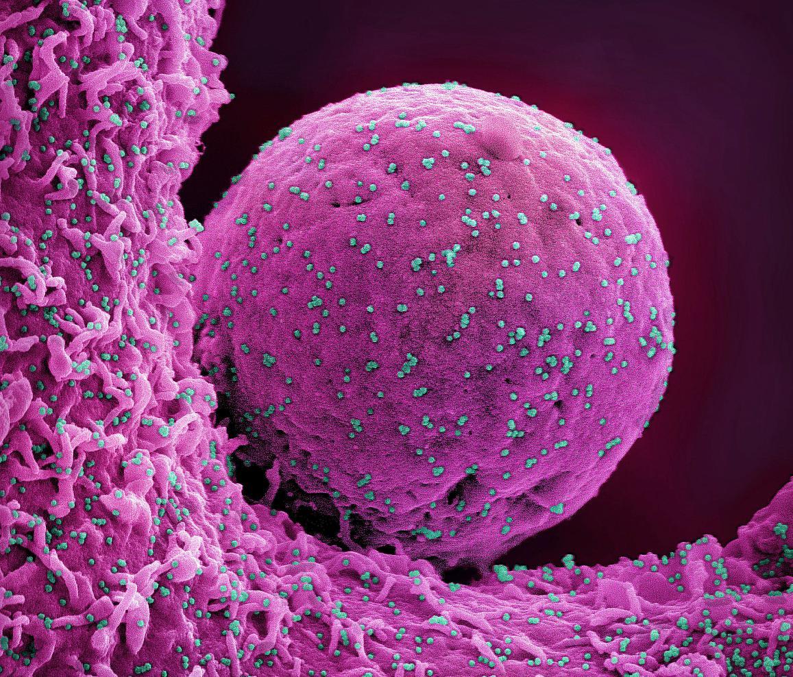 Colorized scanning electron micrograph of a cell (pink) infected with the Omicron strain of SARS-CoV-2 virus particles (teal), isolated from a patient sample. NIAID.