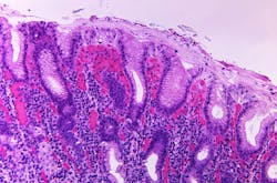 Courtesy of the CDC Courtesy of the CDC