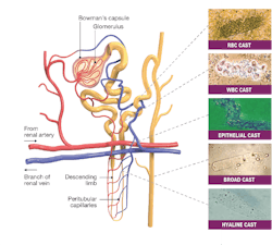 Figure 1: Microscopic images courtesy of Sorin Gîju, Ph.D., Clinical Emergency Hospital Timisoara, Romania. Figure 1: Microscopic images courtesy of Sorin Gîju, Ph.D., Clinical Emergency Hospital Timisoara, Romania.