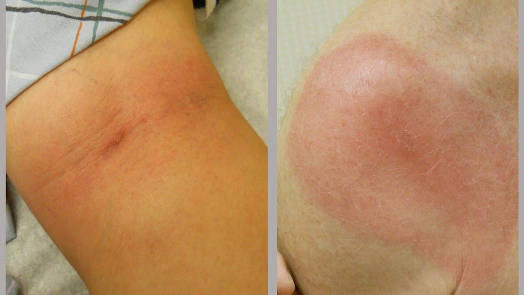 An example of how the rash commonly associated with Lyme disease, erythema migrans, presents in different individuals. Credit: John Aucott, M.D., Johns Hopkins Medicine.