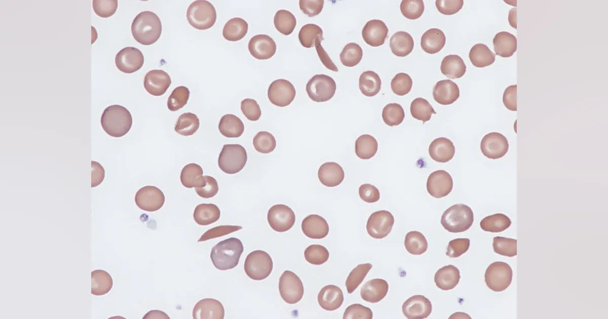 A cure for sickle cell disease | MLO Online