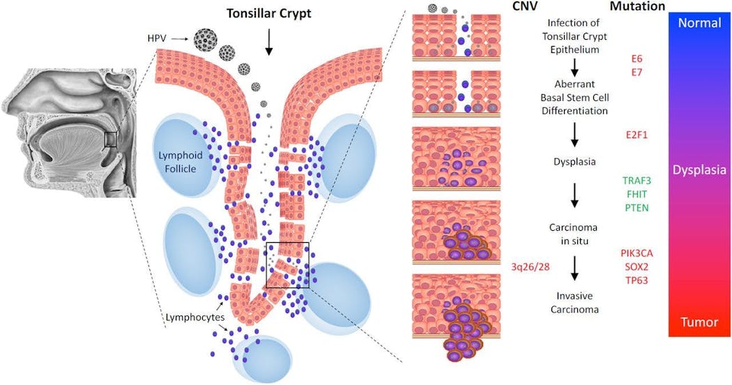 Figure 1: The initiation of HPV infection and subsequent tumorigenesis in cells of the tonsillar crypt.6