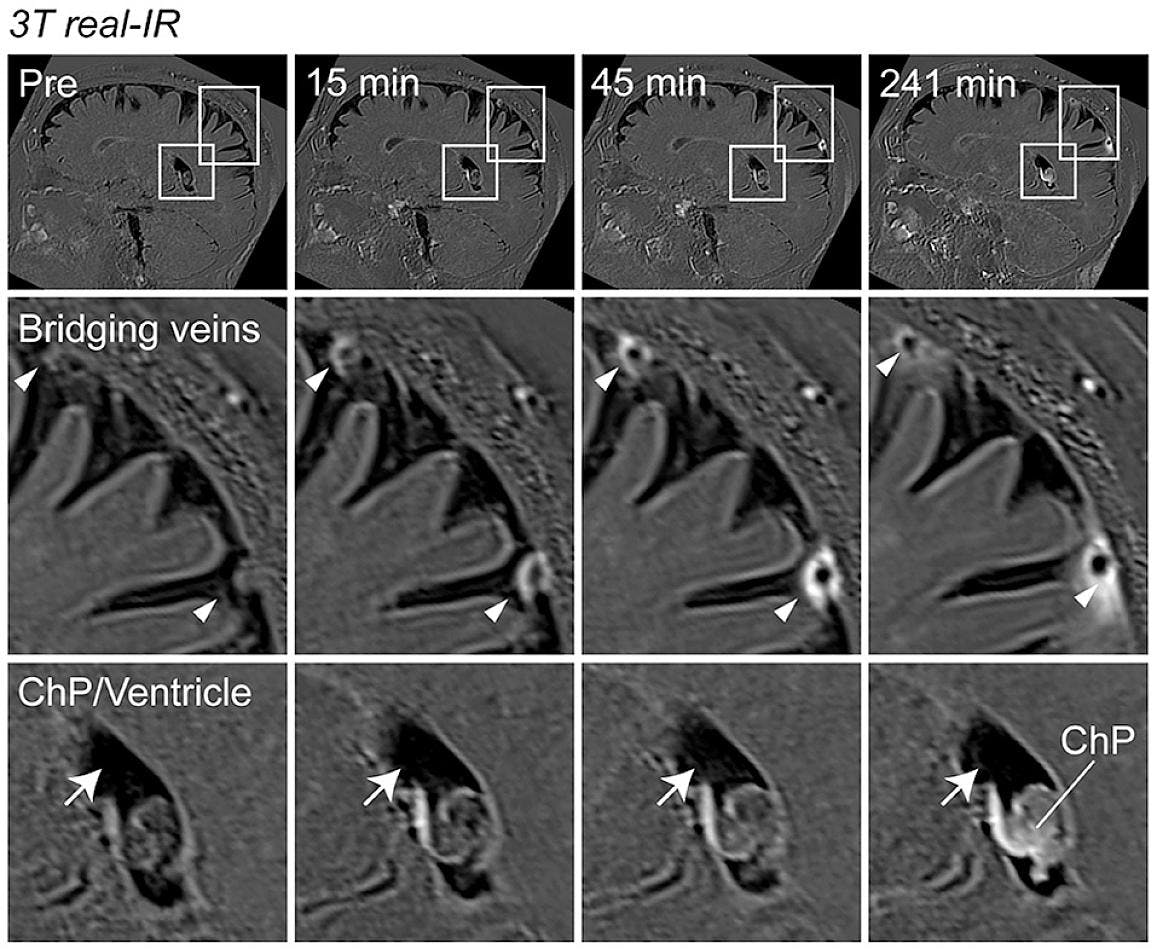 Fluid containing light-emitting molecules was seen to slip through the arachnoid barrier where blood vessels passed through. NINDS.