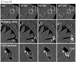 Fluid containing light-emitting molecules was seen to slip through the arachnoid barrier where blood vessels passed through. NINDS. Fluid containing light-emitting molecules was seen to slip through the arachnoid barrier where blood vessels passed through. NINDS.