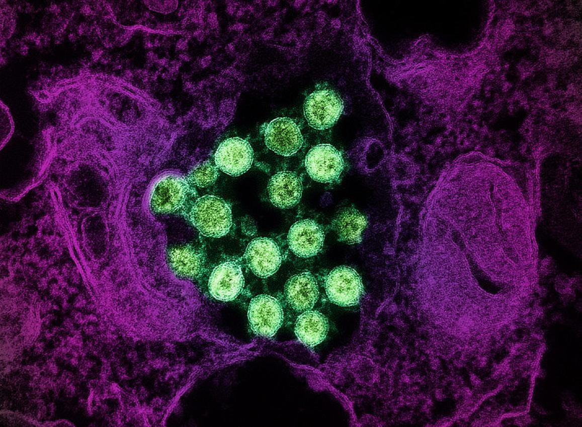 Transmission electron micrograph of SARS-CoV-2 virus particles (colorized green), isolated from a patient sample. NIAID.