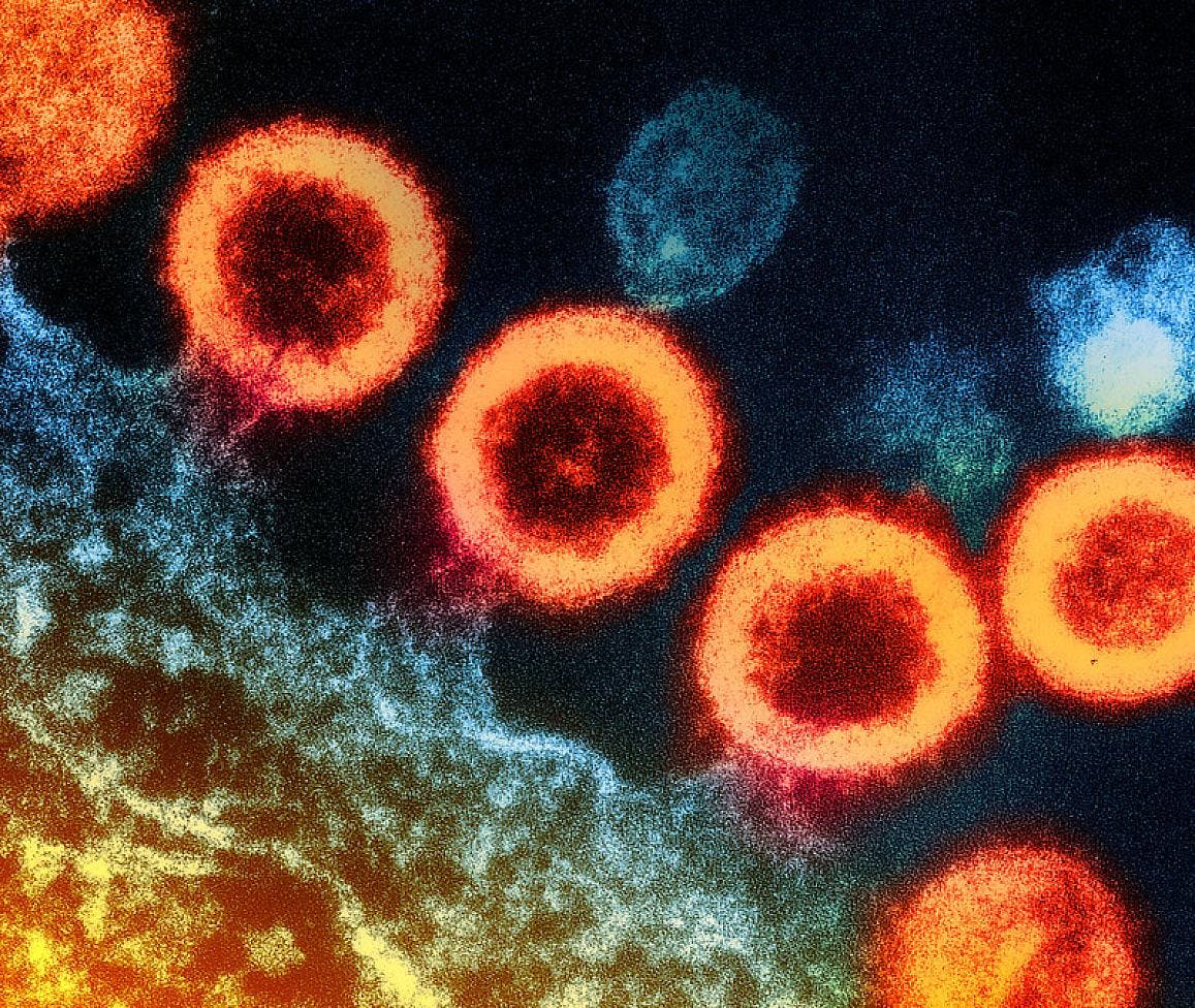 Transmission electron micrograph of HIV-1 virus particles (orange) replicating from the plasma membrane of an infected H9 T cell. NIAID.