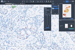 Figure 2: Example of adjunctive quantitative image analysis tool for calculating HER2 gene amplification in breast cancer. Figure 2: Example of adjunctive quantitative image analysis tool for calculating HER2 gene amplification in breast cancer.
