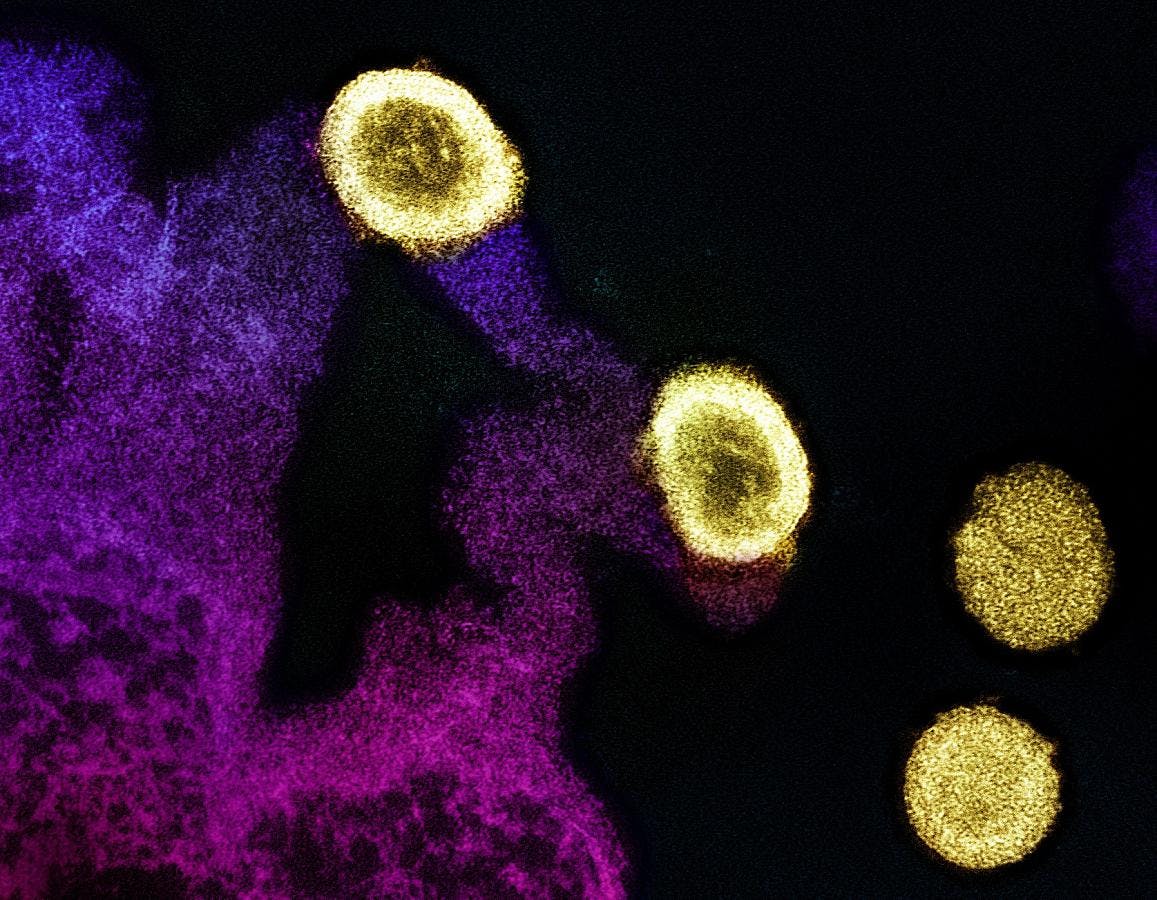 Transmission electron micrograph of HIV-1 virus particles (yellow) replicating from the plasma membrane of an H9 T cell (purple and pink). NIAID.