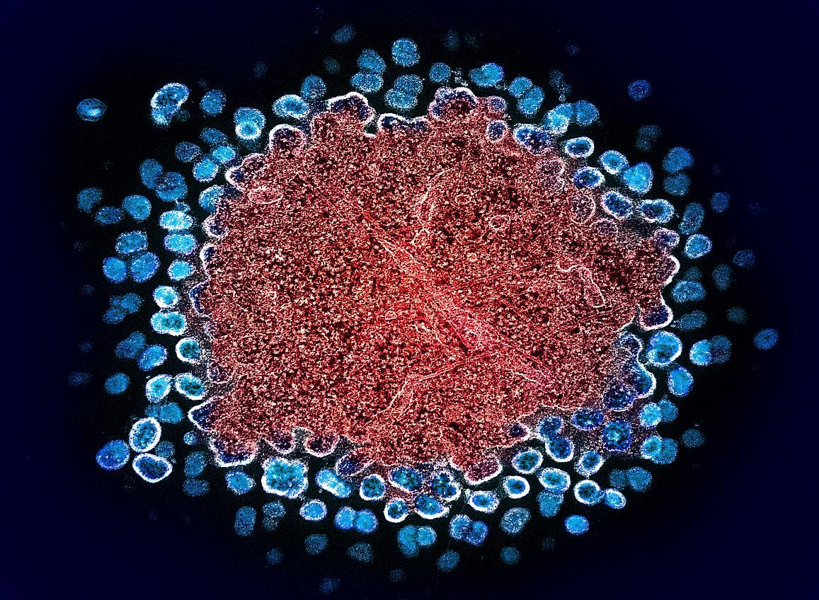 Colorized transmission electron micrograph of numerous HIV-1 virus particles (blue) replicating from a segment of a chronically infected H9 T cell (red). NIAID.