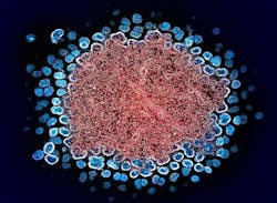 Colorized transmission electron micrograph of numerous HIV-1 virus particles (blue) replicating from a segment of a chronically infected H9 T cell (red). NIAID. Colorized transmission electron micrograph of numerous HIV-1 virus particles (blue) replicating from a segment of a chronically infected H9 T cell (red). NIAID.