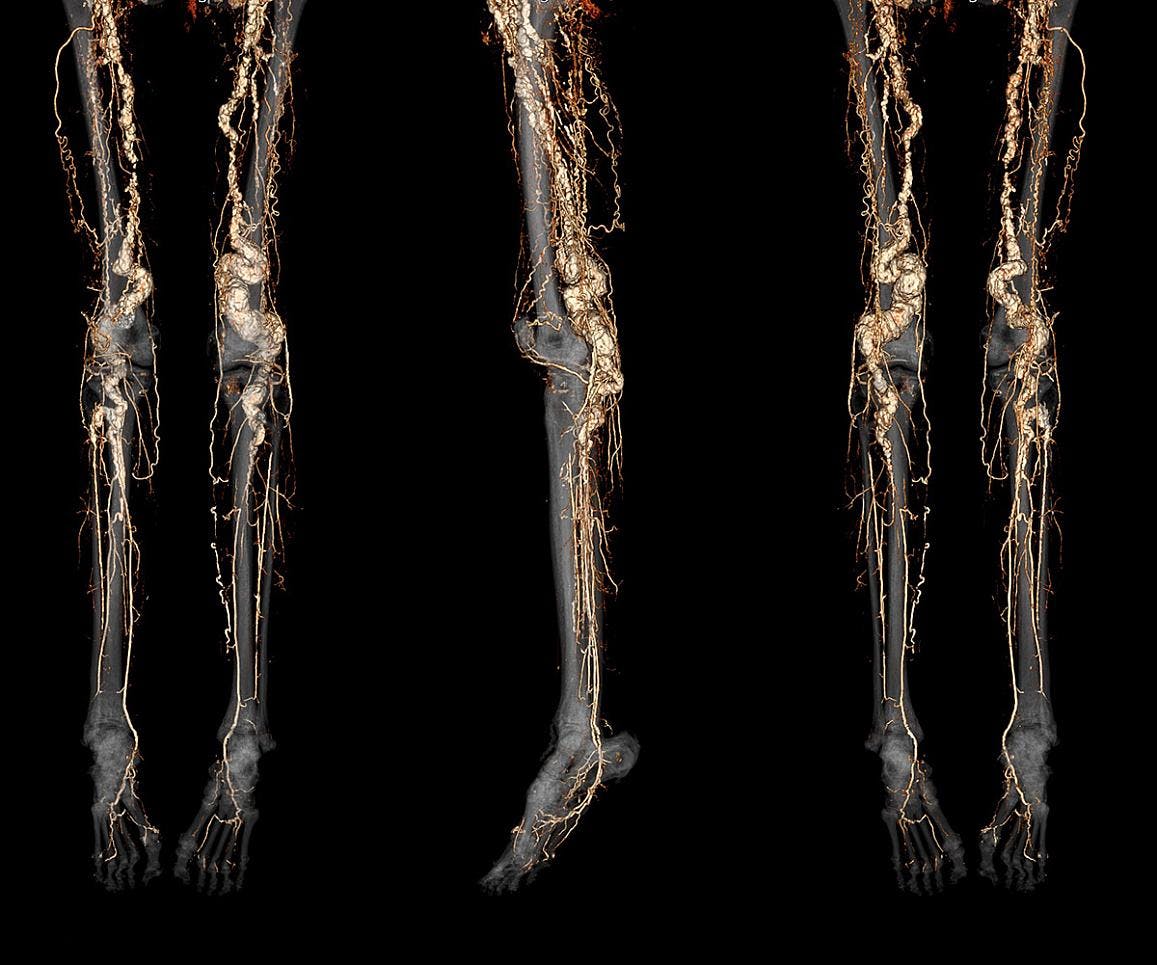 A CT angiography scan of a person with ACDC disease showing abnormal calcification of the blood vessels in the legs and feet. NHLBI.