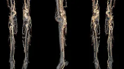 A CT angiography scan of a person with ACDC disease showing abnormal calcification of the blood vessels in the legs and feet. NHLBI.