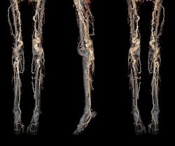 A CT angiography scan of a person with ACDC disease showing abnormal calcification of the blood vessels in the legs and feet. NHLBI. A CT angiography scan of a person with ACDC disease showing abnormal calcification of the blood vessels in the legs and feet. NHLBI.