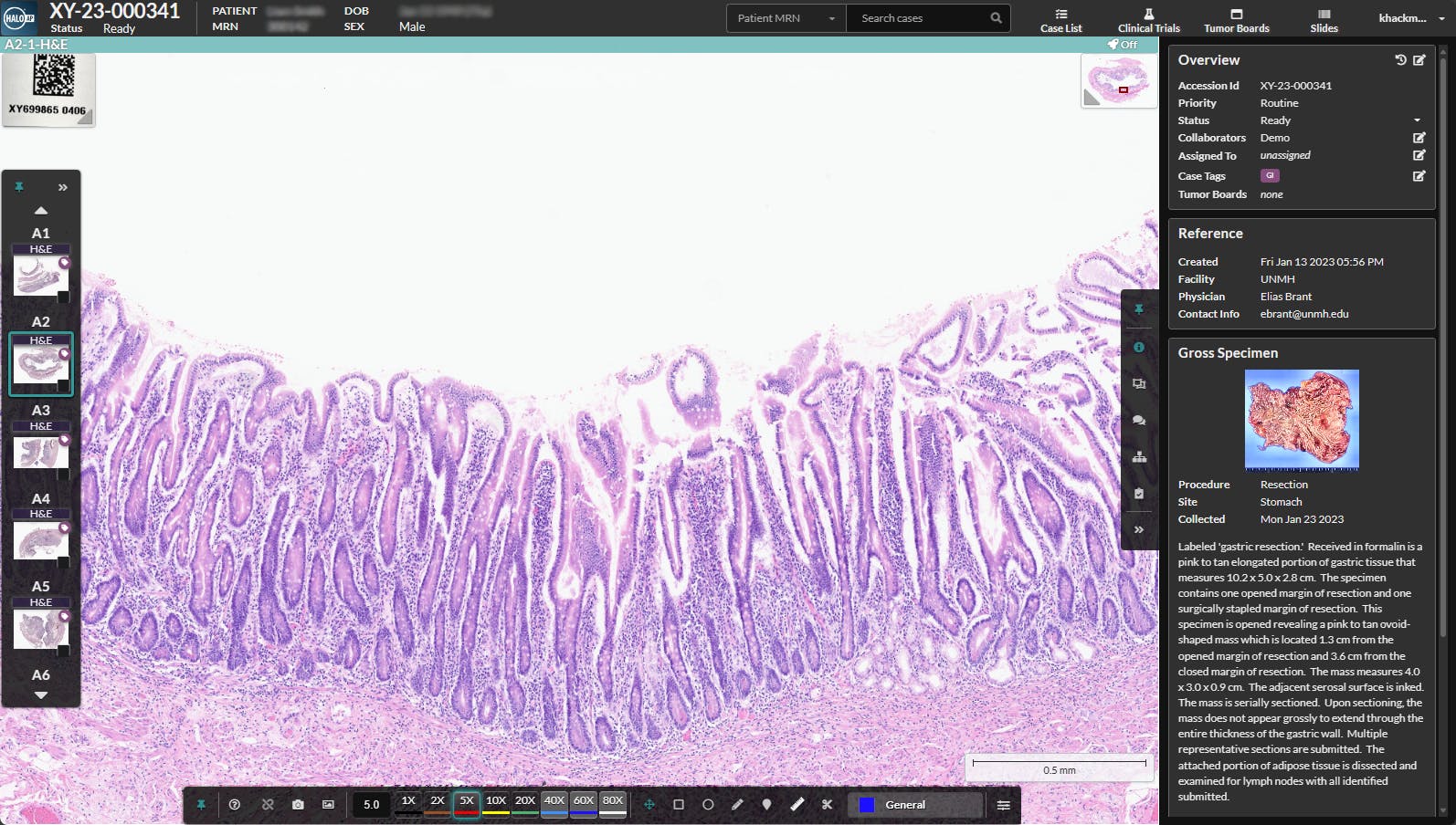 HALO AP Dx brings digital primary diagnosis to anatomic pathology labs in the US. Courtesy of Indica Labs.