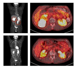 Before treatment with ViPOR, full-body and cross-sectional PET scans of a patient show large lymphoma tumors (circled in the top two panels). Following treatment, the tumors have disappeared (bottom two panels). Center for Cancer Research/National Cancer Institute Alt tag: Image of medical scans that show shrinking tumors in a patient with large lymphoma tumors.