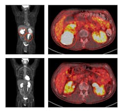 Before treatment with ViPOR, full-body and cross-sectional PET scans of a patient show large lymphoma tumors (circled in the top two panels). Following treatment, the tumors have disappeared (bottom two panels). Center for Cancer Research/National Cancer Institute Alt tag: Image of medical scans that show shrinking tumors in a patient with large lymphoma tumors. Before treatment with ViPOR, full-body and cross-sectional PET scans of a patient show large lymphoma tumors (circled in the top two panels). Following treatment, the tumors have disappeared (bottom two panels). Center for Cancer Research/National Cancer Institute Alt tag: Image of medical scans that show shrinking tumors in a patient with large lymphoma tumors.