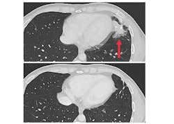 Cross-sectional CT images showing a metastatic tumor in the left lung of a patient (top image) and no tumor following treatment (bottom image). NCI. Cross-sectional CT images showing a metastatic tumor in the left lung of a patient (top image) and no tumor following treatment (bottom image). NCI.