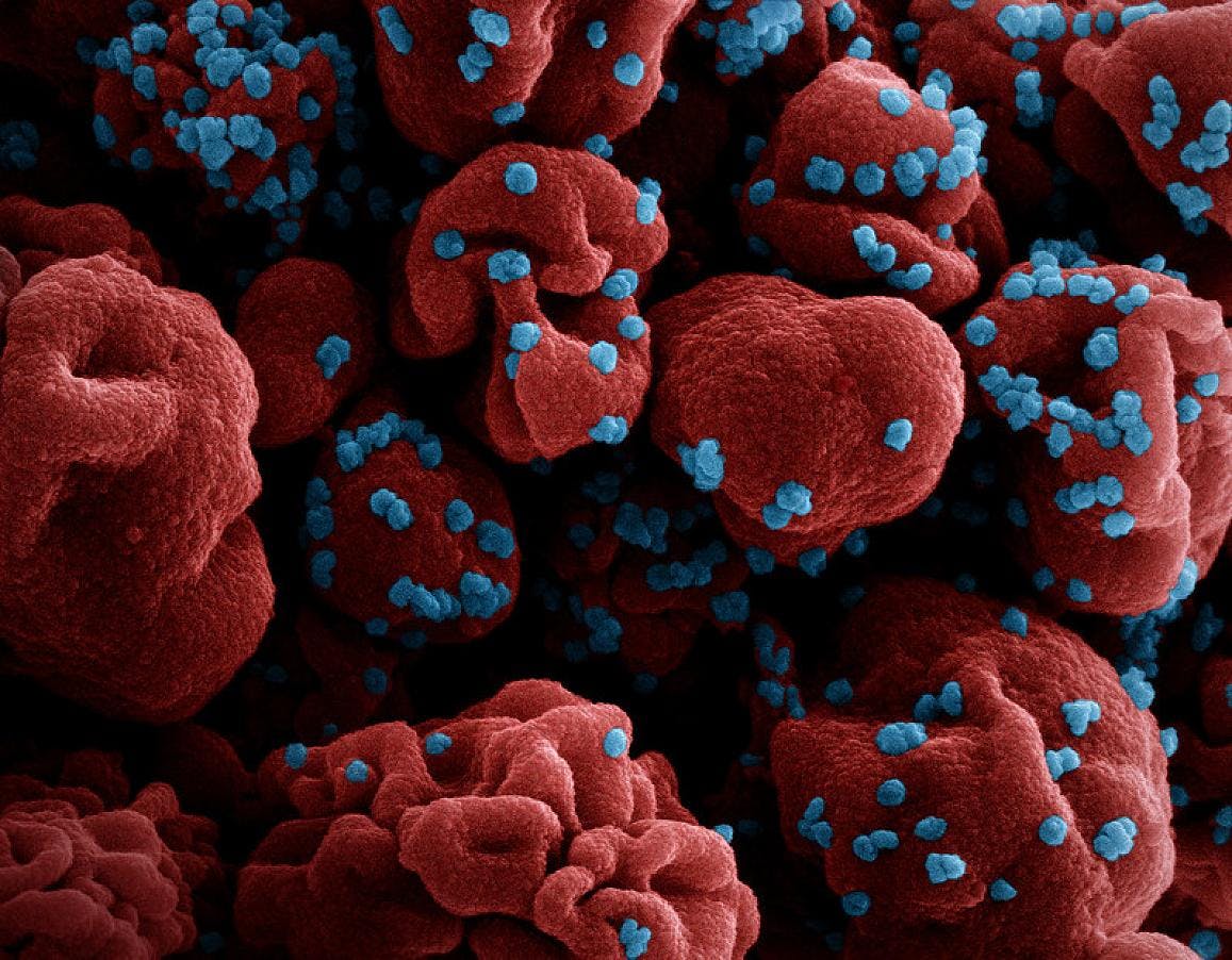 Colorized scanning electron micrograph of a cell (red) infected with SARS-CoV-2 virus particles (blue), isolated from a patient sample. NIAID.