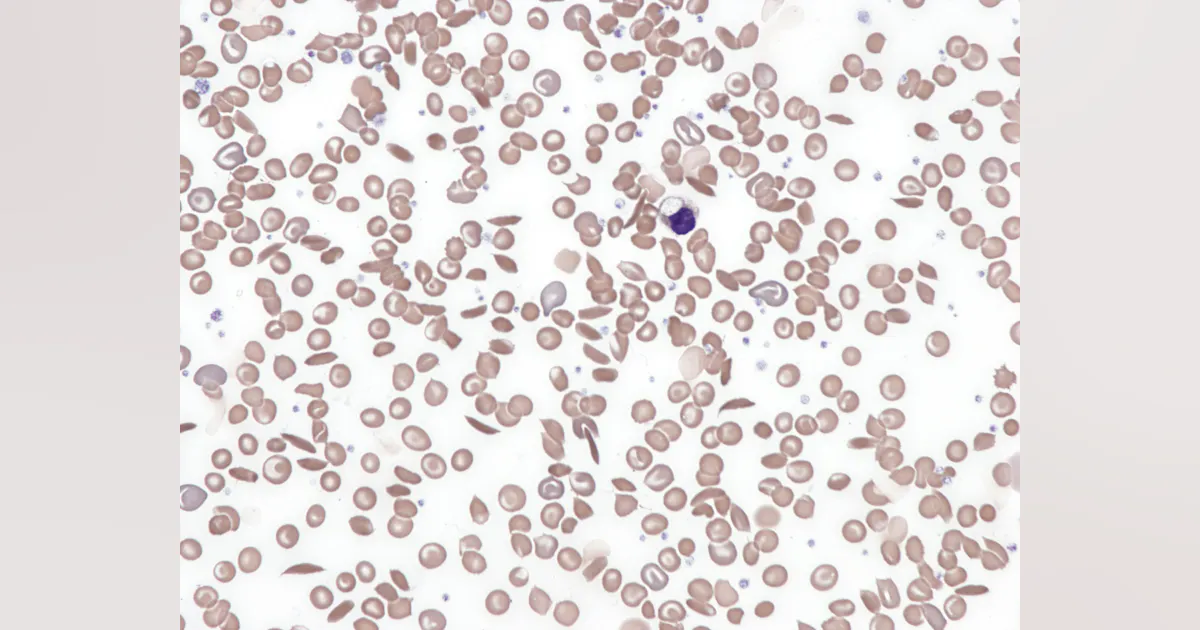 Exploring distress experiences of patients with sickle cell disease ...
