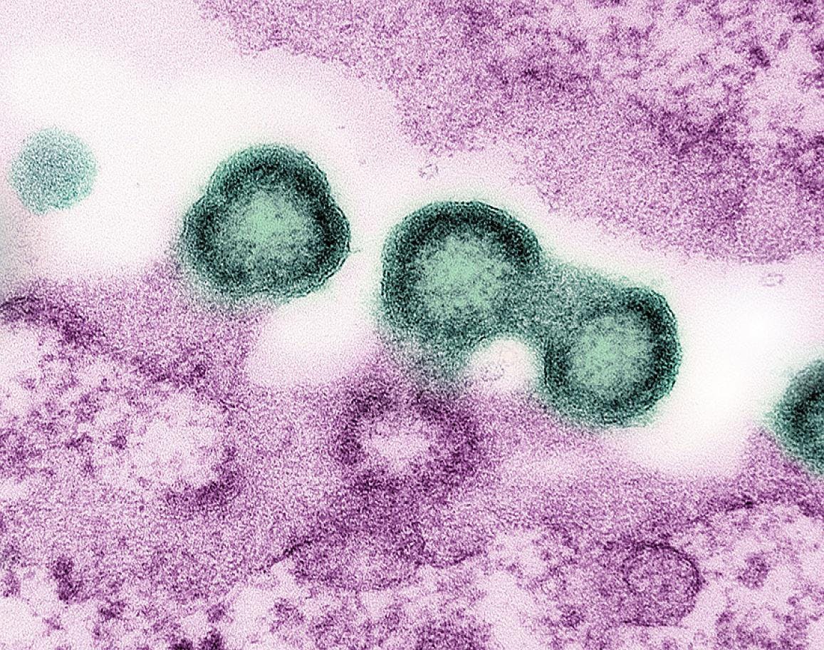 Transmission electron micrograph of HIV-1 virus particles (green) replicating from the plasma membrane of an H9 T cell (pink). NIAID.
