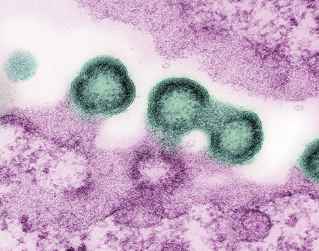 Transmission electron micrograph of HIV-1 virus particles (green) replicating from the plasma membrane of an H9 T cell (pink). NIAID.