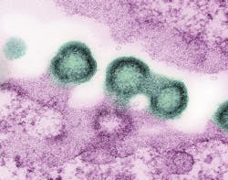 Transmission electron micrograph of HIV-1 virus particles (green) replicating from the plasma membrane of an H9 T cell (pink). NIAID. Transmission electron micrograph of HIV-1 virus particles (green) replicating from the plasma membrane of an H9 T cell (pink). NIAID.