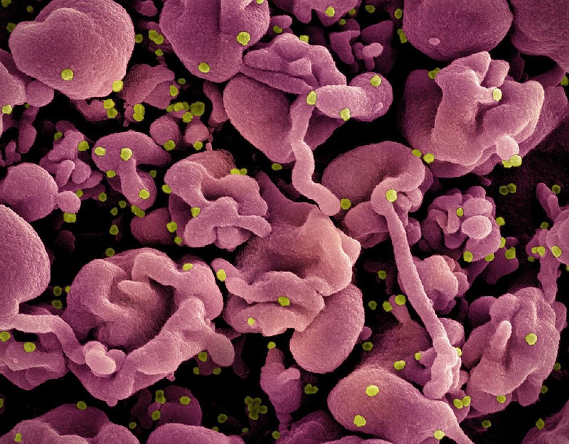 Colorized scanning electron micrograph of a cell (pink) infected with the Omicron strain of SARS-CoV-2 virus particles (yellow), isolated from a patient sample. Image captured at the NIAID Integrated Research Facility (IRF) in Fort Detrick, Maryland. NIAID.