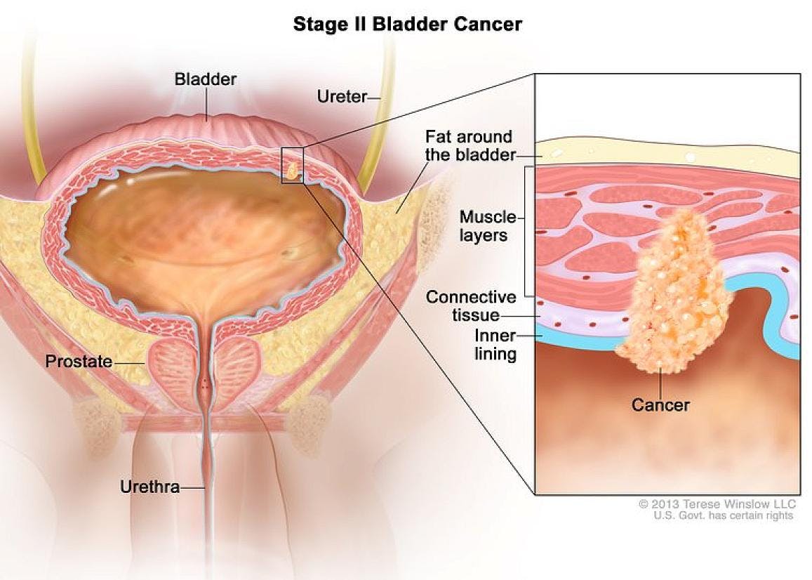Adjuvant pembrolizumab helps people with muscle-invasive bladder cancer remain cancer free longer than with observation alone. National Cancer Institute.
