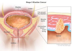 Adjuvant pembrolizumab helps people with muscle-invasive bladder cancer remain cancer free longer than with observation alone. National Cancer Institute. Adjuvant pembrolizumab helps people with muscle-invasive bladder cancer remain cancer free longer than with observation alone. National Cancer Institute.