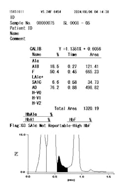 Figure 3. Cation exchange HPLC analyzer for HbA1c testing: HbF > 25%. Figure 3. Cation exchange HPLC analyzer for HbA1c testing: HbF > 25%.
