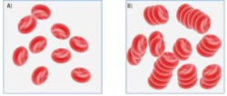 Figure 2. RBCs in a photometric rheology analyzer flow cell. A) Disaggregated RBCs. B) Aggregated RBCs. Figure 2. RBCs in a photometric rheology analyzer flow cell. A) Disaggregated RBCs. B) Aggregated RBCs.